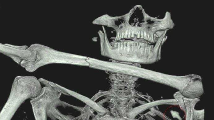 Wende im Fall Ötzi