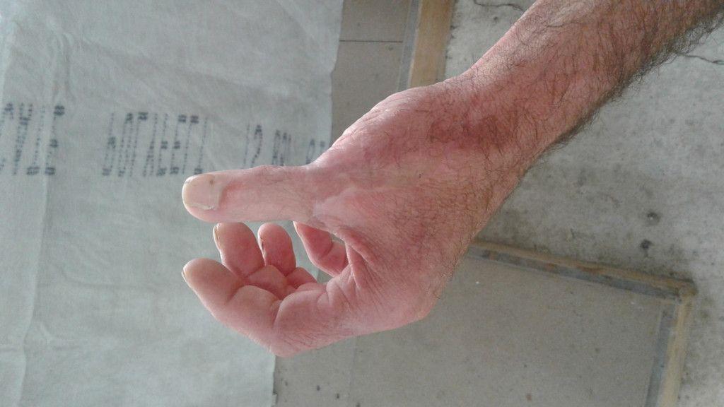 Bilder vom transplantierten Daumen