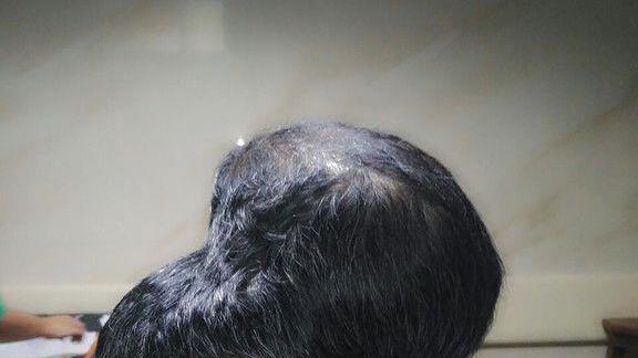 Größter Hirntumor entfernt
