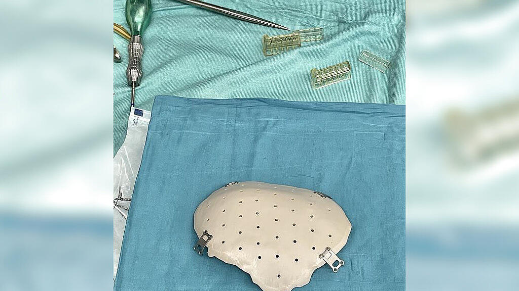 SALK 3D-Drucker Implantat