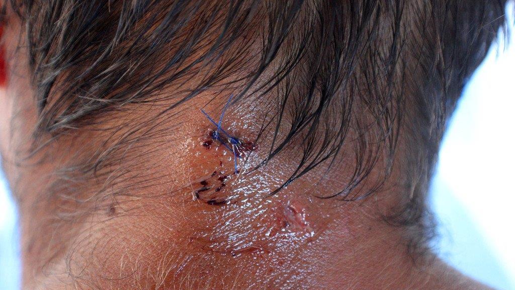 Mann befreite sich durch Schläge aus Maul von Krokodil