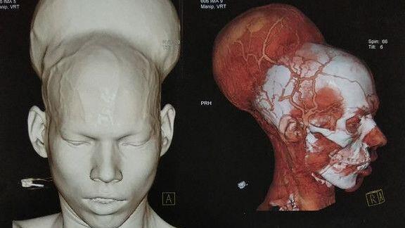 Größter Hirntumor entfernt