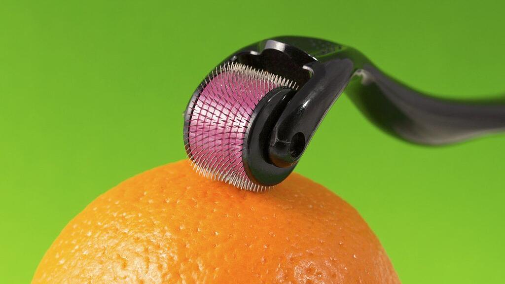 Microneedling kann das Hautbild verbessern.