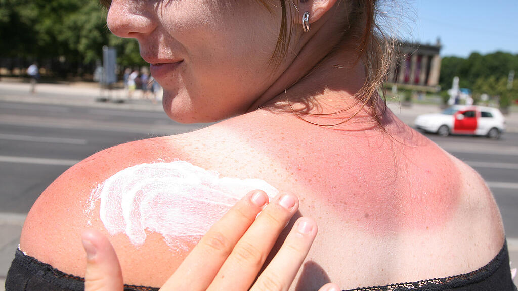 SB: Sonnenbrand