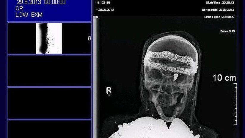 "Mumie" aus Diepholz entpuppt sich als Plastikskelett