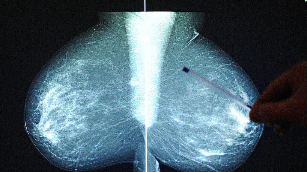 Tumore der Brust bei Frauen häufigste Diagnose