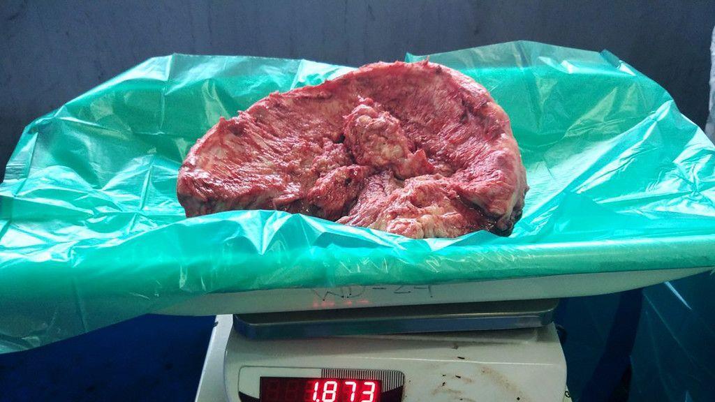 Größter Hirntumor entfernt