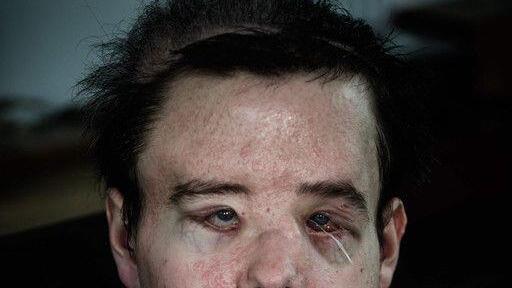 Gesichtstransplantation: Bilder der OP und des Patienten