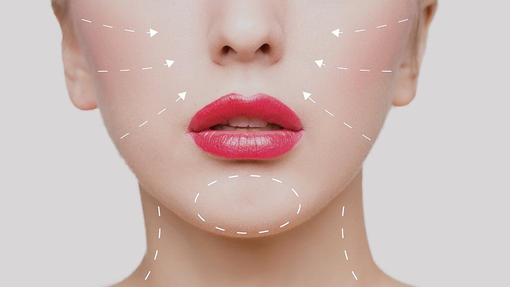 Fadenlifting, ein neuer Beautytrend.