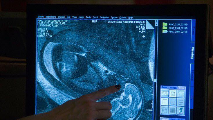 Fötus-Scan: neue Erkenntnisse über Autismus und Schizophrenie erhofft.