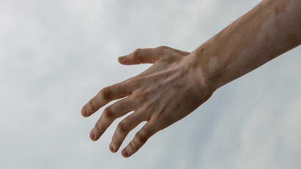 vitiligo.jpg