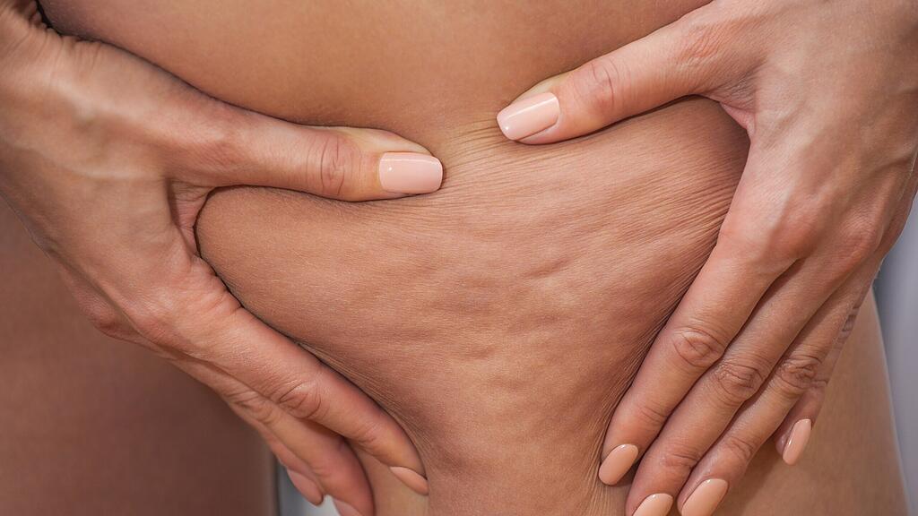 Gegen Cellulite kann man etwas tun.