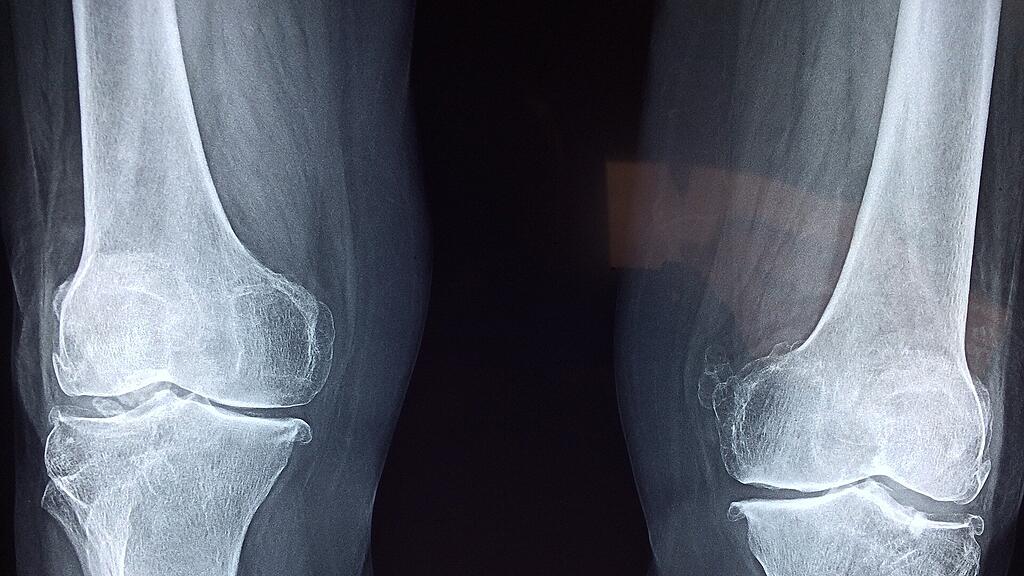 Knochen, Röntgen, Knie, SB