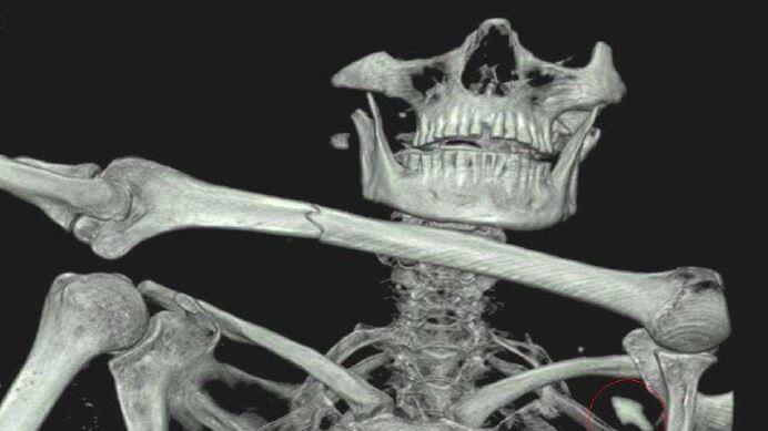 Über eine Wende im Fall Ötzi berichtet das internationale Büro für Geoarchäologie.