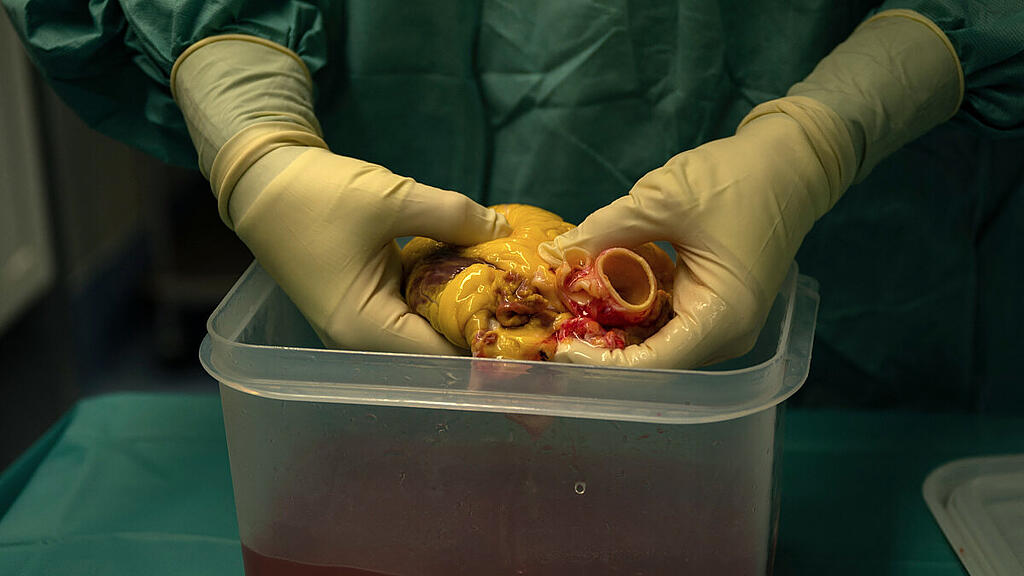 829 Patienten befinden sich auf Wartelisten für ein geeignetes Organ