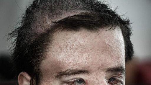Gesichtstransplantation: Bilder der OP und des Patienten
