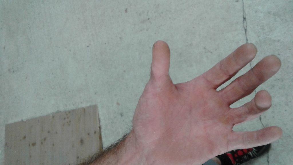 Bilder vom transplantierten Daumen