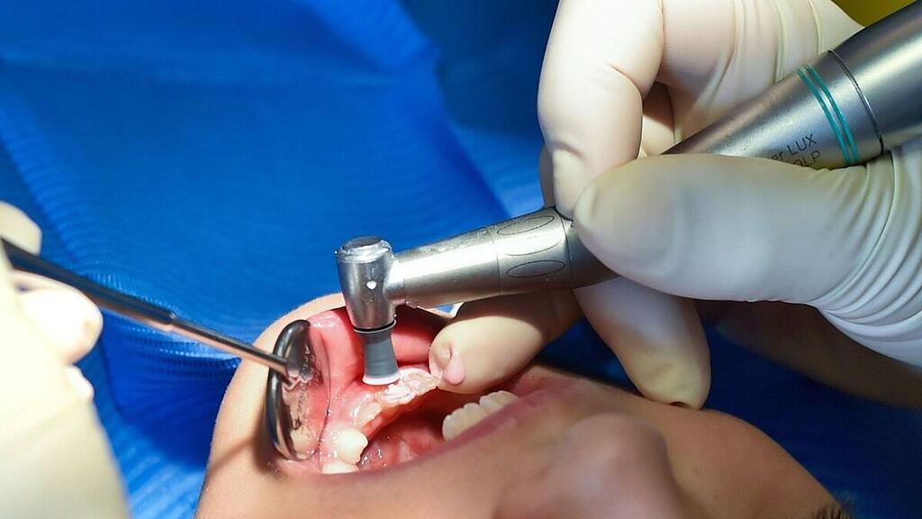 Zahnfüllungen ohne Amalgam sorgen für Streit