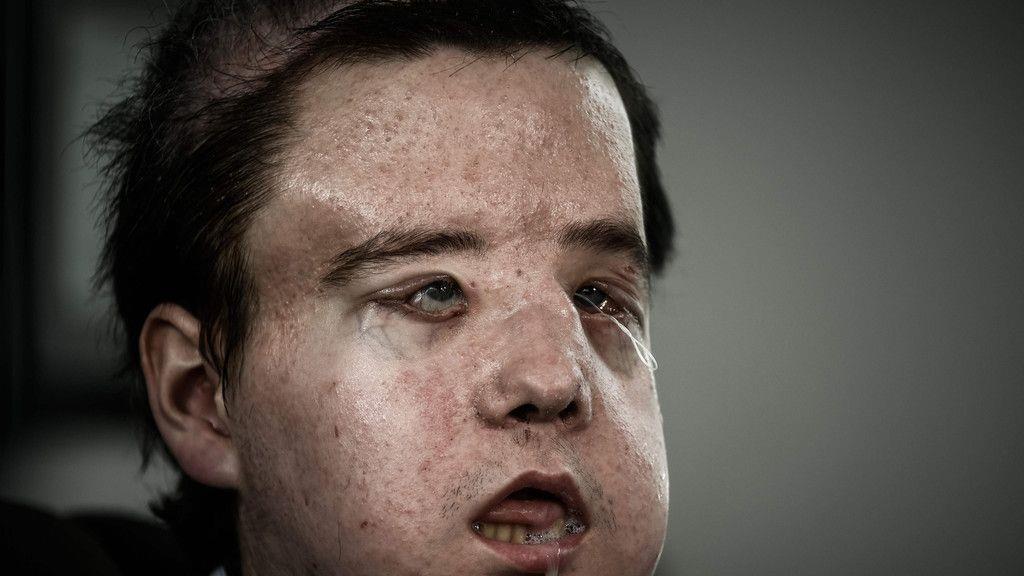 Gesichtstransplantation: Bilder der OP und des Patienten